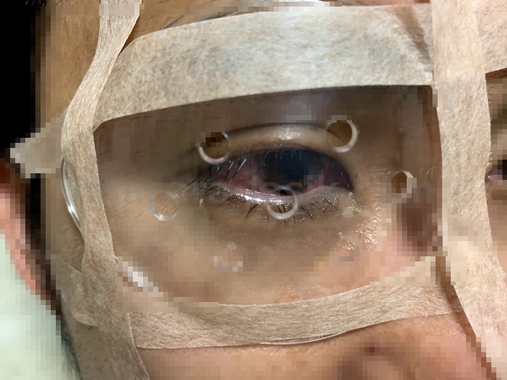 ICL手術後の眼帯の固定法